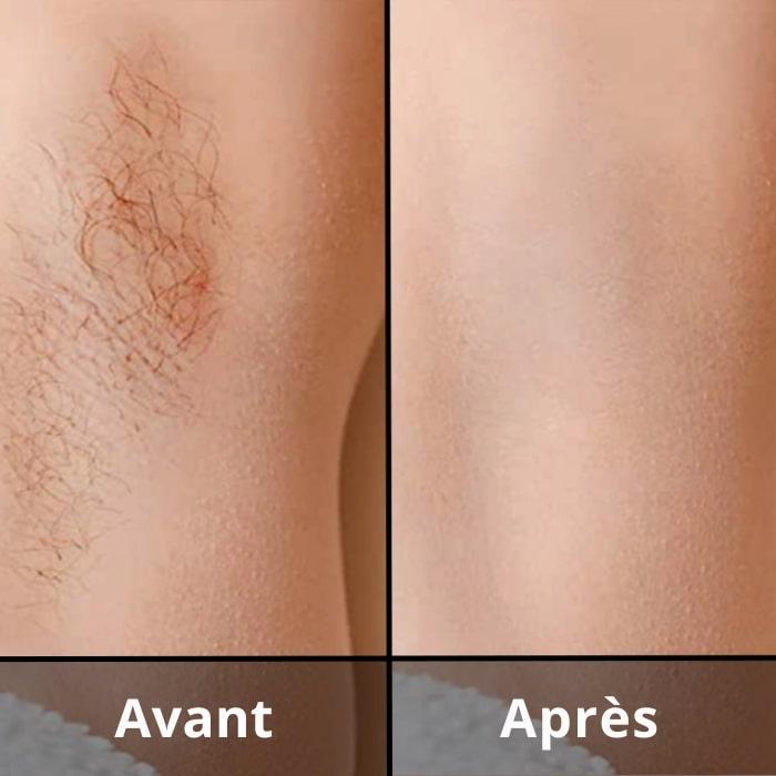 ODYLLA® - ÉPILATEUR IPL